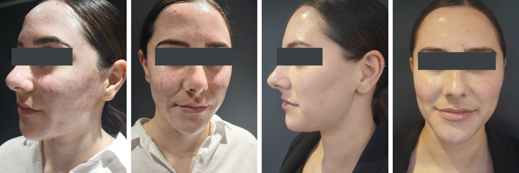 acne treatment before and after temple skincare & spa