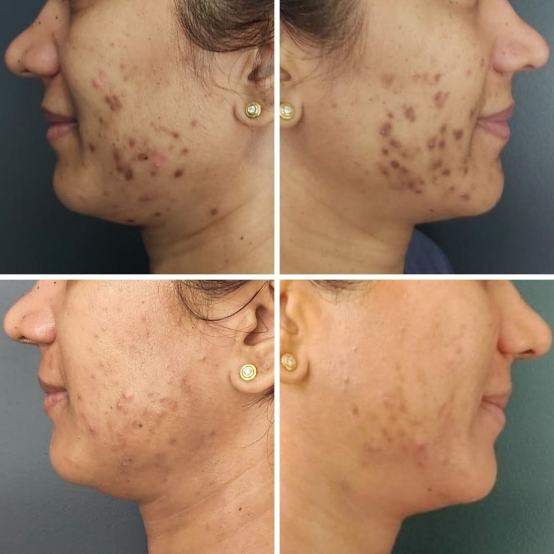 acne treatment program temple skincare & spa day spa medi spa sydney