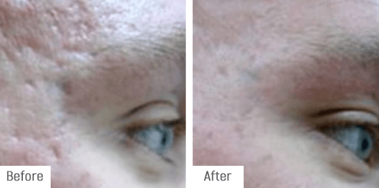 Scarring Treatment results